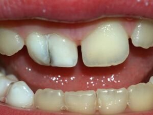 milk teeth in Arabic